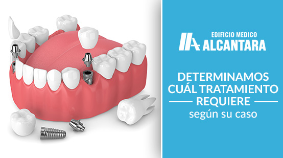 Rehabilitacin Oral Render 3D de Implantes y Piezas Dentales