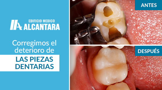 Rehabilitacin Oral Antes y Despus de Reparar Pieza Dentaria Rota