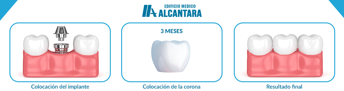 Proceso de Colocacin de Implantes Dentales