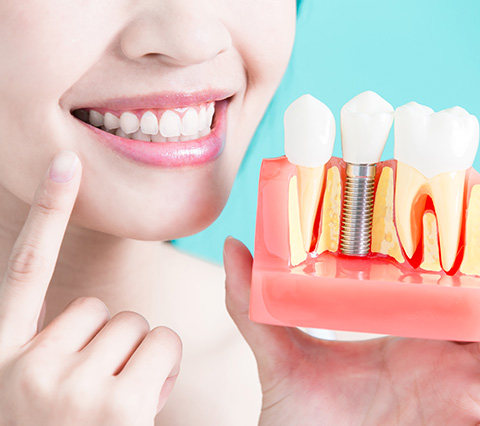 Si necesita una pieza dental busque sus implantes dentales en Santiago Paciente mostrando tipos de implantes dentales en Santiago