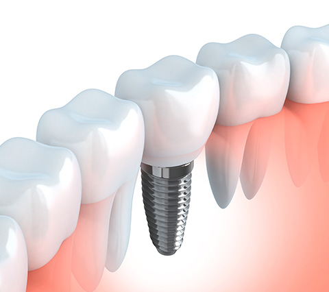 Los implantes dentales en Santiago no se notan Implantes dentales en Santiago, en la boca