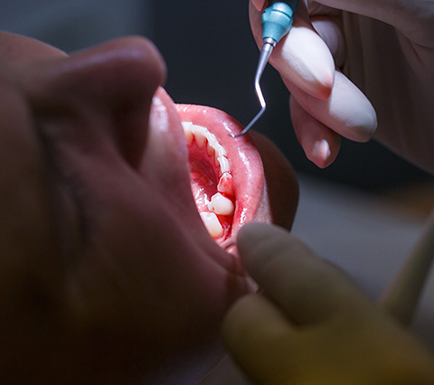 En Alcántara atendemos todas las urgencias dentales en Santiago Hombre que recurre al odontólogo por urgencias dentales en Santiago