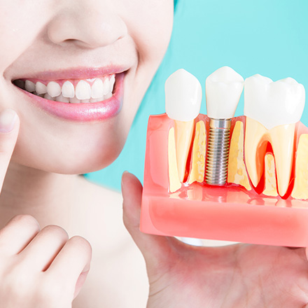 Implantes Dentales Presentados por Doctora