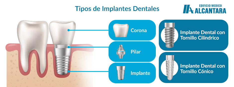 Tipos de Implantes Dentales Infografa 