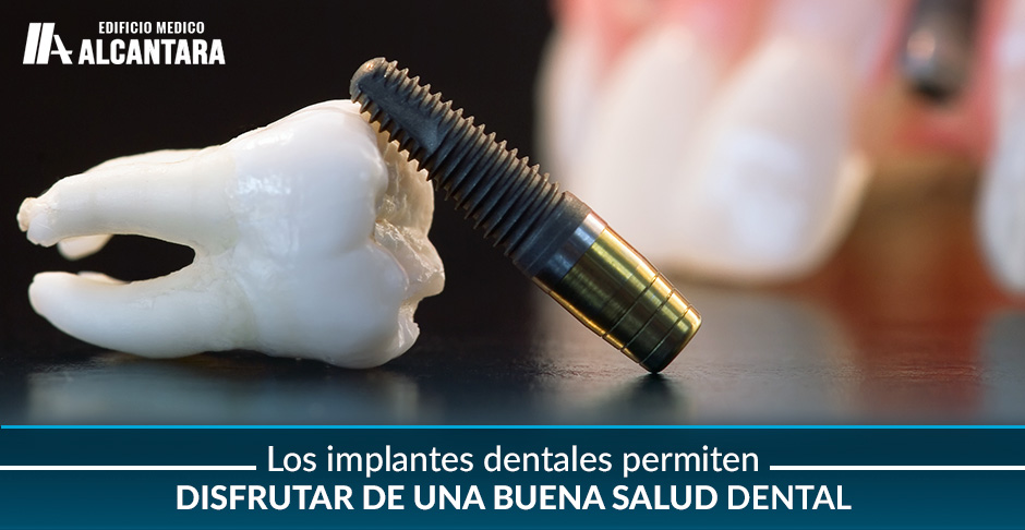 Tipos de Implantes Dentales Corona y Tornillo en Exhibicin  