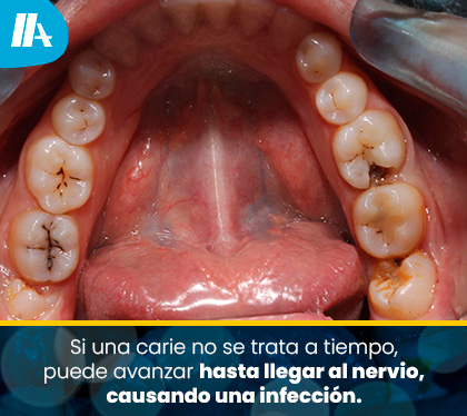 Dolor de Diente Insoportable por Caries