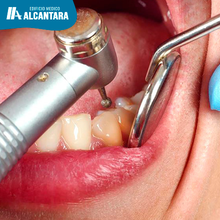 Descubre la Importancia de la Limpieza Dental Profunda: el Cuidado Periodontal para Encas Sanas