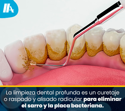 Limpieza Profunda Dental para Eliminar la Placa y el Sarro
