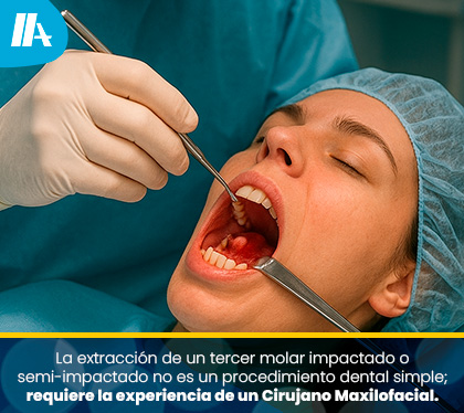 Extracción de las Muelas del Juicios