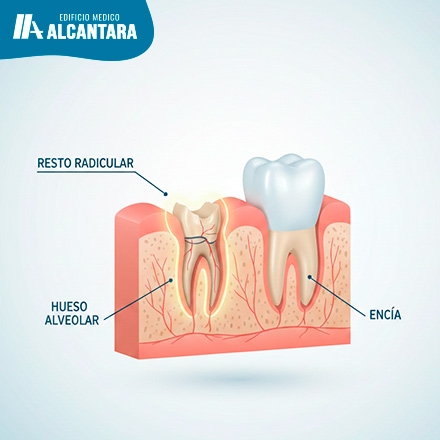 �Qu� es un Resto Radicular y Por Qu� No Deber�as Ignorarlo?