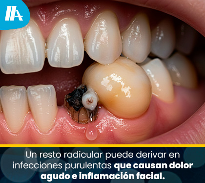 Resto Radicular Dental Infestado