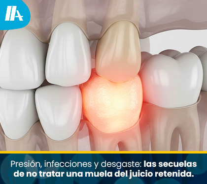 ender 3D detallado de una mand�bula que muestra la presi�n ejercida por una muela del juicio retenida sobre el segundo molar y la enc�a circundante, resaltando la zona con un tono c�lido de advertencia.