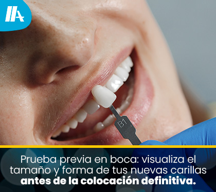 Paciente observando en un espejo la prueba maqueta (mock-up) de sus carillas puestas temporalmente sobre sus dientes antes de tallar o cementar.