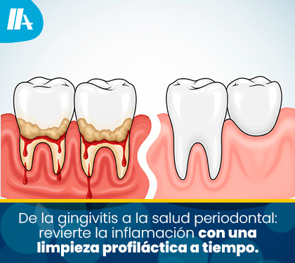 Ilustraci�n comparativa que muestra una enc�a inflamada y sangrante por sarro versus una enc�a sana, firme y de color rosado p�lido.