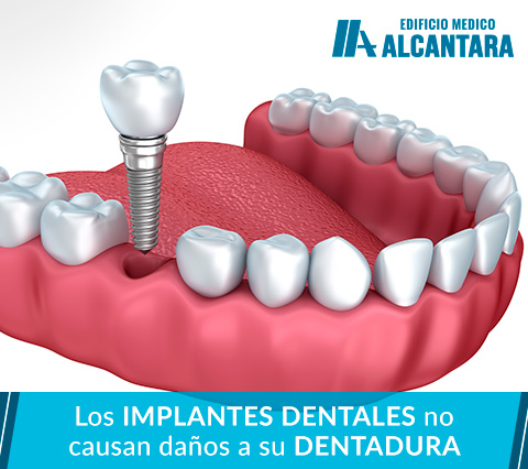 Ejemplo de implantes dentales en Santiago