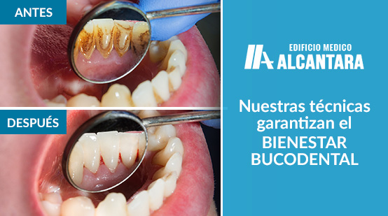 Rehabilitacin Oral Antes y Despus de Realizar Limpieza Bucodental