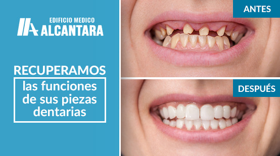 Rehabilitacin Oral Antes y Despus de Prtesis Maxilar superior