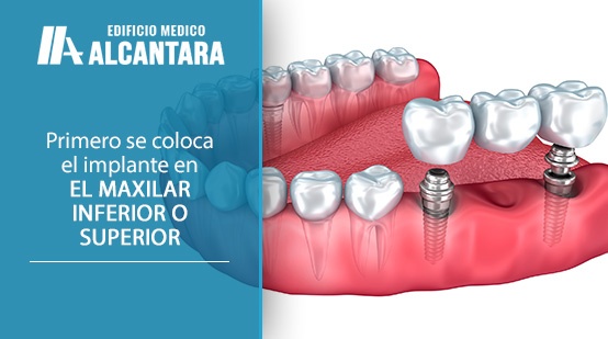 Implantes Dentales en Santiago 3D Render Pasos Para Colocarlos