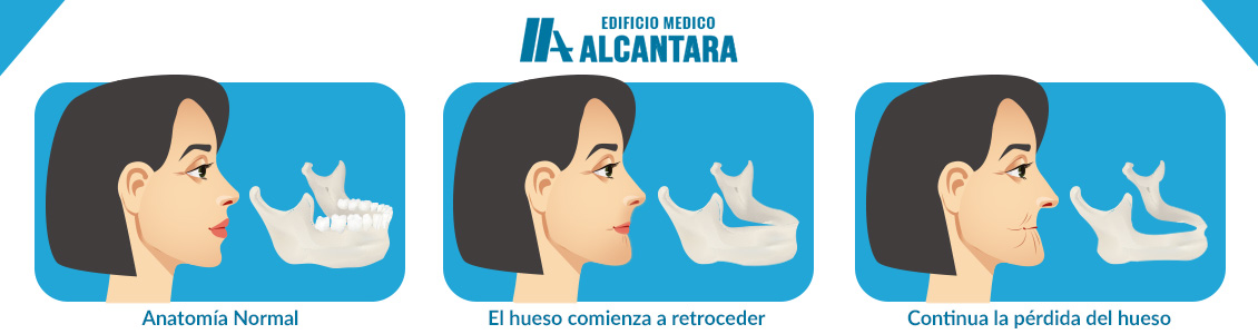 Consecuencias de no Utilizar Implantes Dentales 