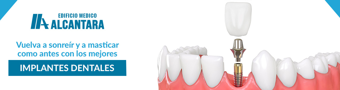 Imagen de Implantes Dentales