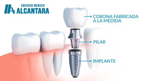 Partes de una Prtesis Dental