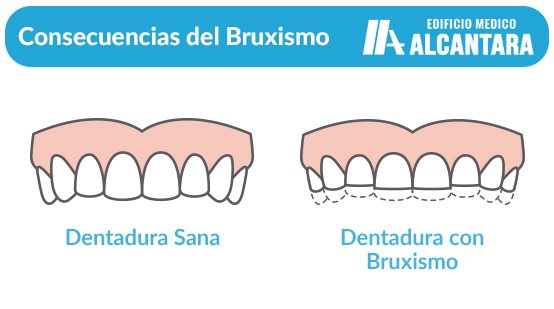 Trastorno Temporomandibular Ilustracin de Consecuencias