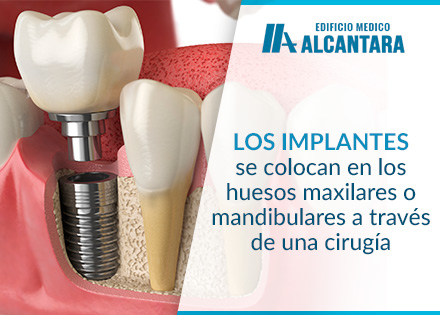 Proceso de Implantes Dentales