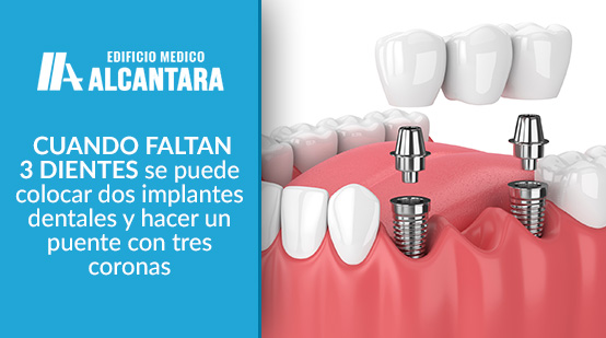 Implantes Dentales con Tres Coronas