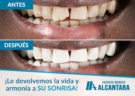 Urgencia Dental Fractura de Diente Antes Despus