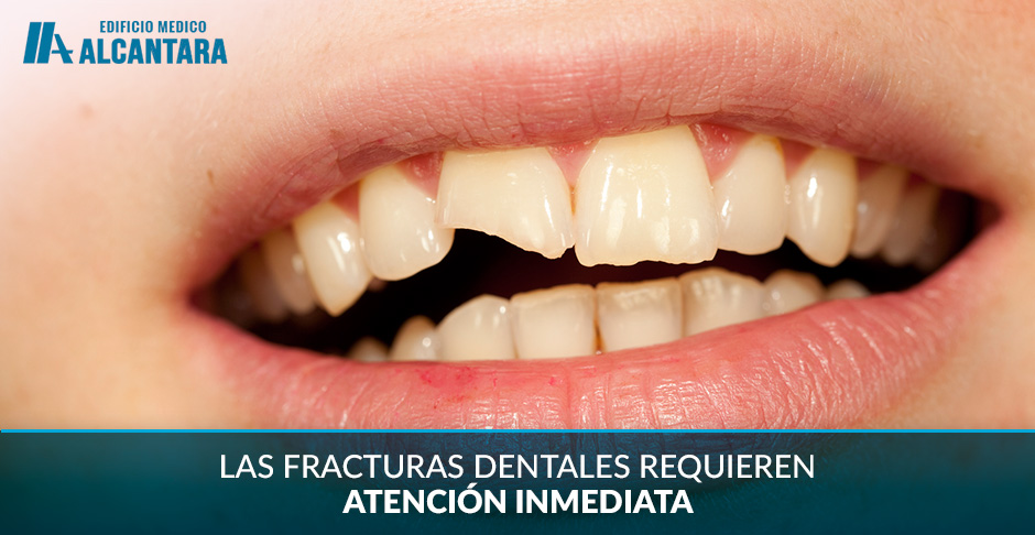 Urgencia Dental Fractura de Diente 