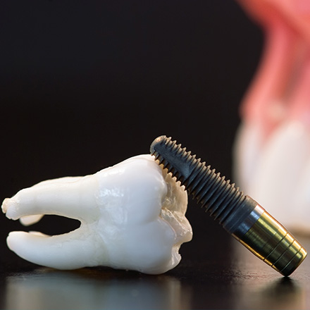 Tipos de Implantes Dentales Corona y Tornillo en Exhibición  