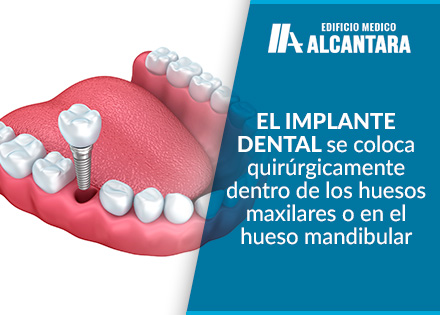 3D Render de Tipos de Implantes Dentales 