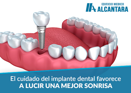 Implante Dental Higiene Bucal 3D Render de Implantacin