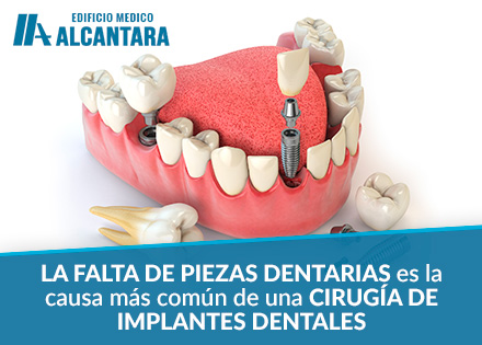 Ciruga de Implantes Dentales Pieza Dentaria Cada