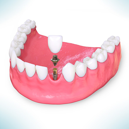 Modelo Cirugía de Implantes Dentales
