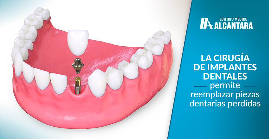 Modelo Ciruga de Implantes Dentales