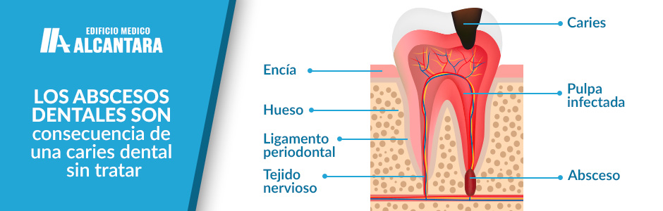 Urgencia Dental Absceso Dental Infografía de la Infección