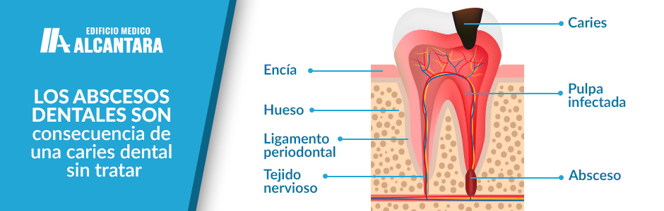 Urgencia Dental Absceso Dental Infografa de la Infeccin