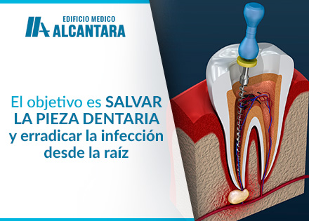 Urgencia Dental Absceso Dental Tratamiento de Conducto