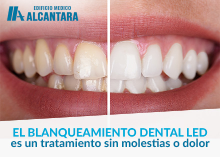 Blanqueamiento Dental LED Sonrisa Antes y Después
