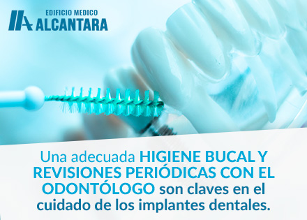 Cunto Cuesta un Implante Dental y Cmo es su Cuidado.