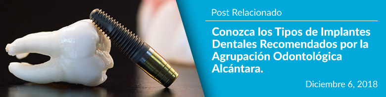 Conozca los Tipos de Implantes Dentales Recomendados por la Agrupacin Odontolgica Alcntara - Post Relacionado