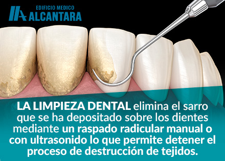 Ilustracin para Aprender a Cmo Prevenir la Enfermedad Periodontal Eliminando el Sarro.