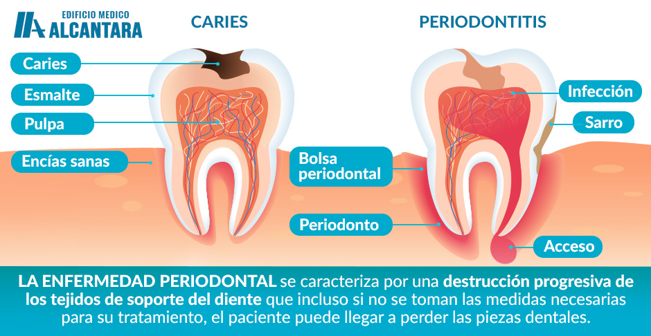 Ilustracin para Aprender a Cmo Prevenir la Enfermedad Periodontal