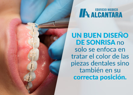 Dentista Realiza Ortodoncia Aplicacada para el Diseo de Sonrisa.