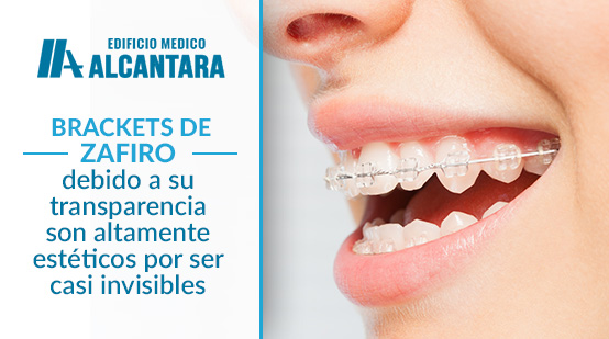 Brackets de Zafiro en Joven Sonriente 